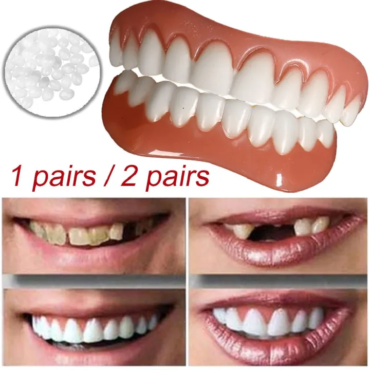 veneer gigi