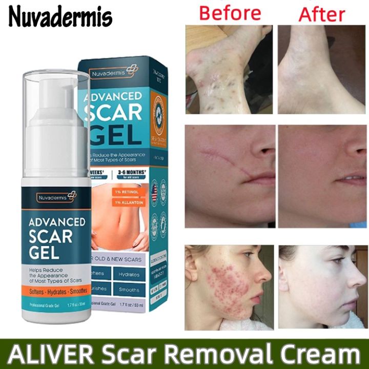 ADVANCED SCAR GEL Acne Scars Treatment Scar Removal Cream Acne Scar ...