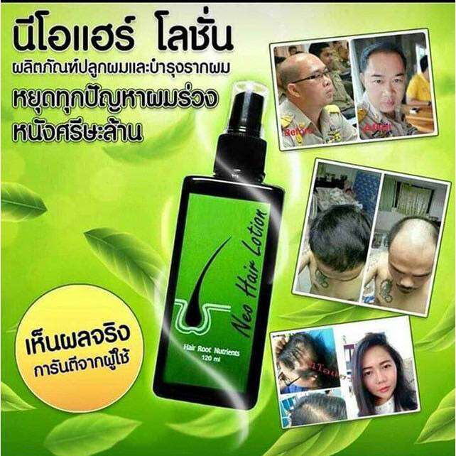 neo-hair-lotion-ของแท้-5-ขวด-เซรั่มปลูกผม-นีโอแฮร์โลชั่น-neohair-นีโอแฮร์-ของแท้-5-ขวด