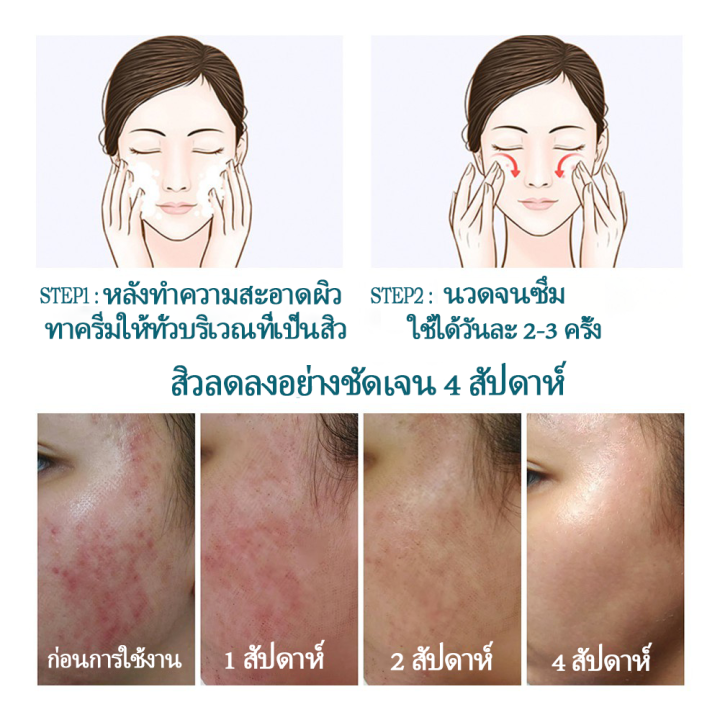 hemeiel-ครีมกำจัดสิวเสี่ยน-ทุกประเภท-สำหรับสิวอักเสบ-ลดสิว-รอยสิว-สามารถลดสิว