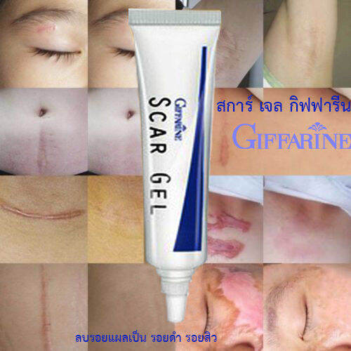 hot-sale-กิฟารีนสการ์-เจลลบรอยแผลเป็นรอยดำรอยสิว-ปริมาณ15กรัม-1หลอด-รหัส14005-lung-d-ของแท้100