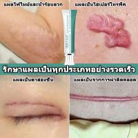 breylee ของแท้ ครีมลดแผลเป็น ครีมลบแผลเป็น scar removal cream ยาทาแผลคีลอยด์ ครีมทาแผลผ่าคลอด  ลบลอยแผลเป็น ลดแผลไฟไหม้ แผลน้ำร้อนลวก ครีมทาแผลผ่าตัด