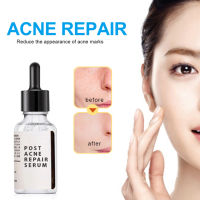 30ml Salicylic Acid 2% Solution Removes Acne Face serum Shrinks Pore Moisturizing Essence Fade Spot Brighten Face Skin Care