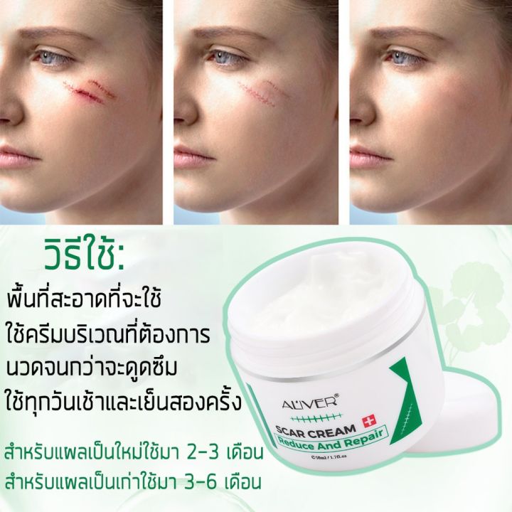 10วันเห็นผล-aliver-ครีมลดรอยแผลเป็น-50ml-แผลไฟไหม้-รอยสิว-รอยแตกลาย-รอยแผลเป็นเป็นต้น-ซ่อมแซมผิวหนัง-ช่วยให้แผลเป็นหายไปอย่างสมบูรณ์-แนะนำโดยหมอจีนเน้นยาโบราน-ครีมลดรอยสิว-ครีมทาแผลเป็น-ครีมบำรุงหน้า-