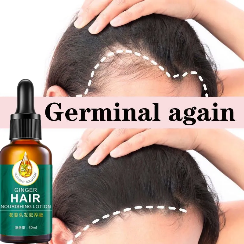 Minoxidil Fast Hair Growth Treatment Essence hair Serum Ginger Essential  Anti Hair Loss | Lazada PH