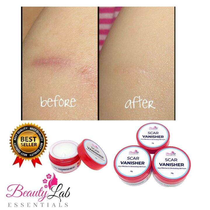 Scar Removal Cream (10g) Beauty Essentials Scar Vanisher Scar