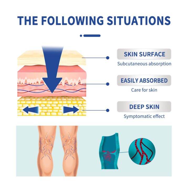 เส้นเลือดขอดบรรเทาอาการครีม-vasculitis-ขา-phlebitis-หลอดเลือดดำรูปแมงมุมครีมบรรเทาอาการปวด-angiitis-กำจัดหลอดเลือดโป่ง