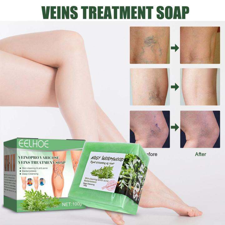 [HOT K] Ginger Varicure Treatment Soap Varicose Veins Cream Vasculitis