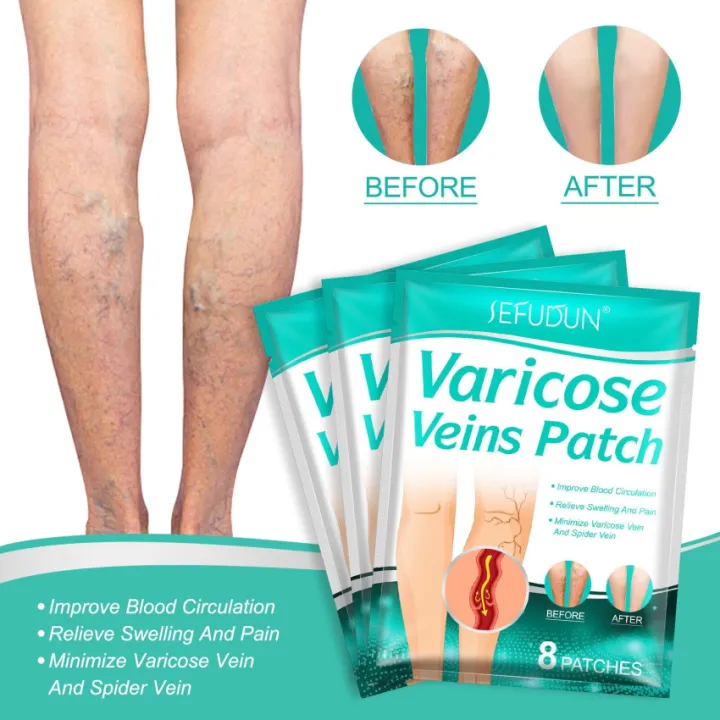 8pcs Varicose Veins Patch Relief Leg Vasculitis Spider Varicose Vein ...