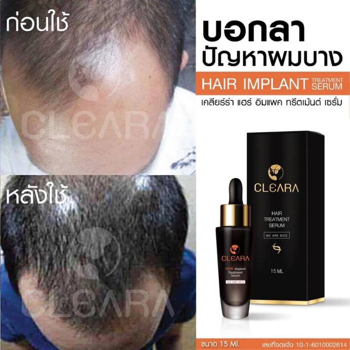 ส่งฟรี-cleara-สเปร์บำรุงรากผม-1-ขวด-บอกลาหัวล้าน-ผมบาง-ผมหนาขึ้น-บำรุงเส้นผม-รากผมแข็งแรงขึ้น-ลดการหลุดร่วง-50ml-เคลียร์ร่า