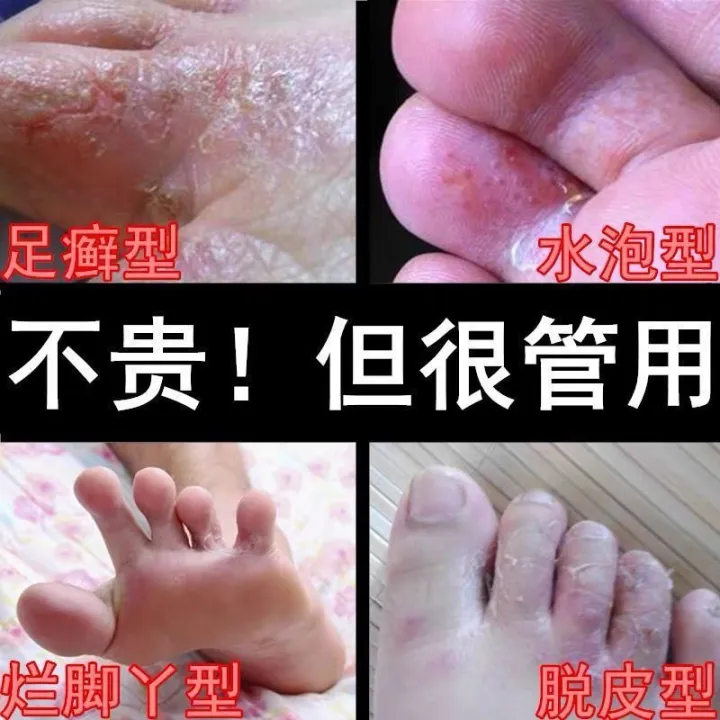 To beriberi itching foot peeling blisters bad feet feet smelly bane