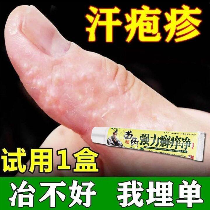 Moss tinea manuum foot cream moss foot fungus infection of hand ...