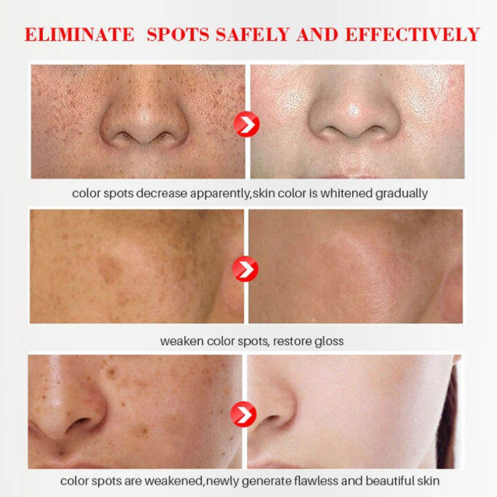 zwm-hot-stings-whitening-freckles-cream-remove-melasma-dark-spots-lighten-เมลานิน-melasma-remover-moisturizing-brighten-face-skin-care