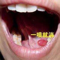 Spray gush out [it] sublingual gland cyst polyp tonguebase oral mucous glands grow a knot ones body sensation