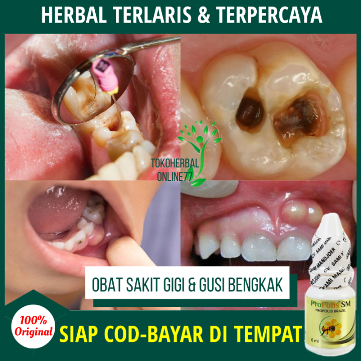 PROPOLIS SM Obat Sakit Gigi Berlubang Dan Gusi Bengkak, Infeksi Radang ...