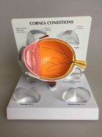 Supply eye model eye lesions corneal lesions eye model medical teaching materials