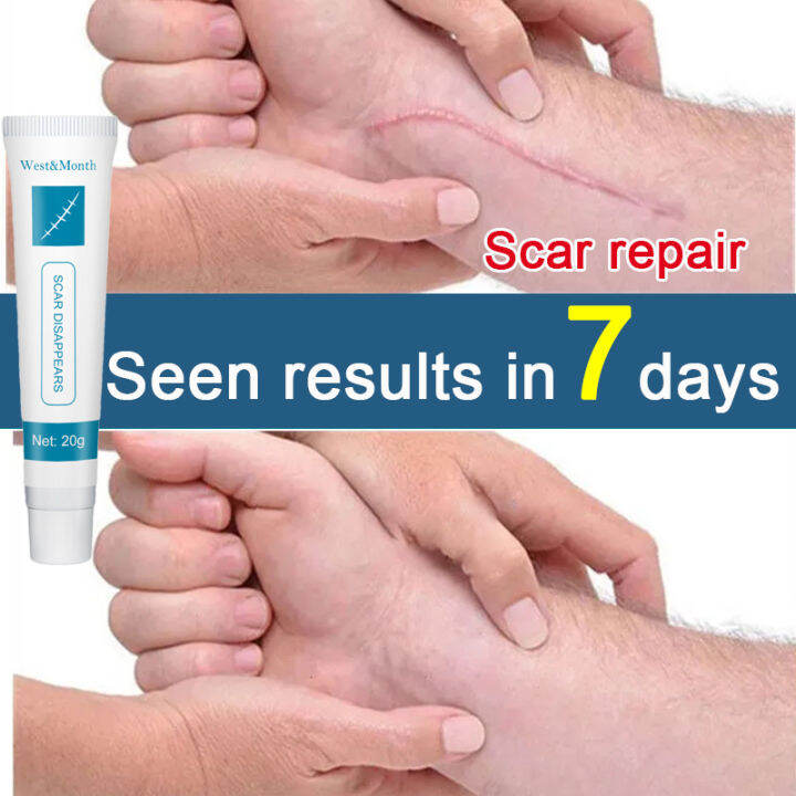 Acne Scar Removal Cream Scar Silicone Gel Ointment Scars Section Pimple