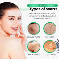 Aloe Natural Wart Removal Soap Moisturizing Skin Mole Eliminating Soap Universal for All Skin Types