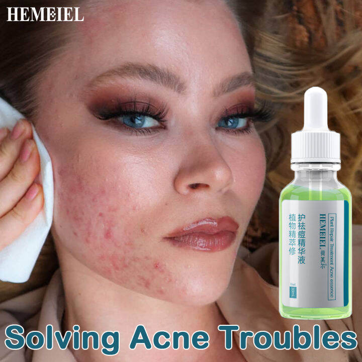 HEMEIEL Effective Acne Serum Remove Acne Scars Serum Acne Repair Serum Remove Pimples Quickly