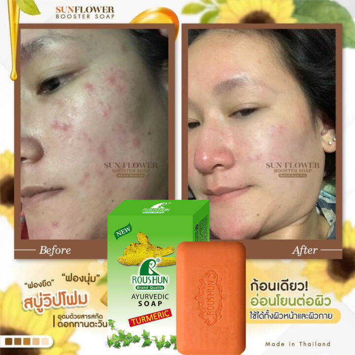 Original Turmeric Soap 75g good for pimples, acne whitens skin turmeric leaf soap pure