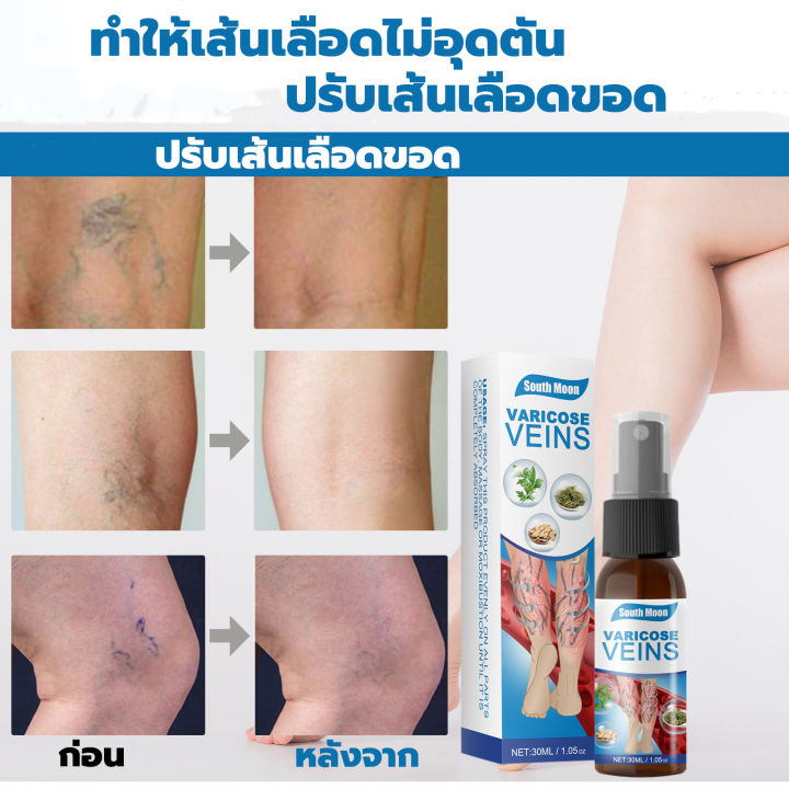 south-moonเส้นเลือดขอด30ml-บอกลาขาไส้เดือน-บอกลาเส้นเลือดขอดเส้นเลือดอุดตัน-ทาอาการปวด-ครีมทาเส้นเลือดขอด-ครีมเส้นเลือดขอด-ยาเส้นเลือดขอด-ยาทาเส้นเลือดขอด-ยารักษาเส้นเลือดขอด-แมงมุมเส้นเลือดปวด-ครีมทา