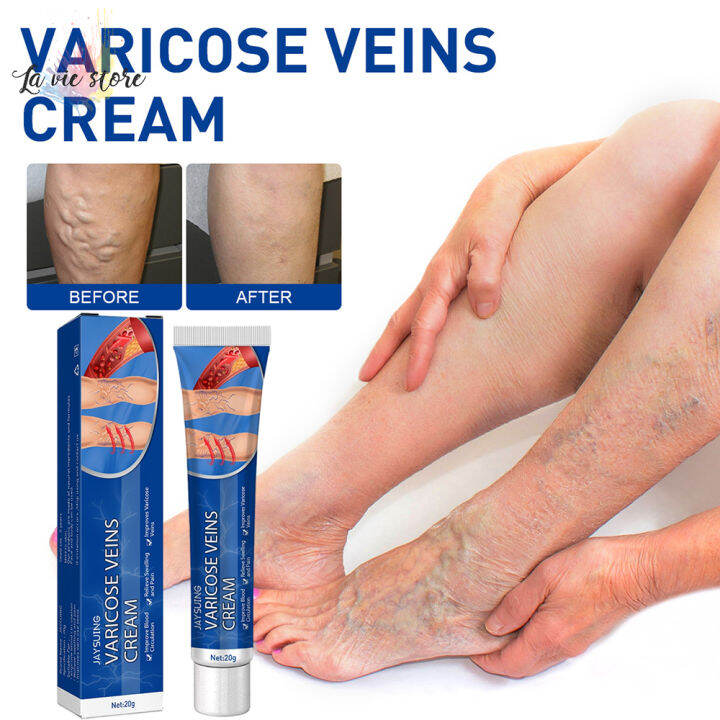 [La vis] Varicose Veins Cream Vasculitis Relief Phlebitis Angiitis