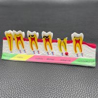 SALE อุปกรณ์ทันตกรรม Caries Classify Tooth Model of Pathological Process Around Teeth Caries Evolution Decayed Model ความงามและของใช้ส่วนตัว ของใช้ส่วนตัว ดูแลช่องปาก