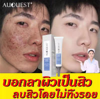 AuQuest ครีมลดสิว ผิวเรียบเนียน ผิวใสบริ๊งค์! Acne cream กำจัดสีว สิวอุดตัน สิวผด ไม่มีหัว หลุมสิว ซ่อมแซมรอยสิว ลอกสิวเสี้ยน กำจัดสิว ทำความสะ