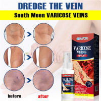 Varicose Veins Healing Spray Smoothing Blood Vessels Earthworm Spray Leg Swelling Pain Relief Health Product S6-TOP1A-TH