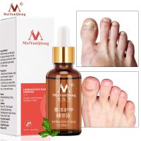 MeiYanQiong Nail Fungal Feet Care Essence Nail Foot Removal Serum Anti Infection Paronychia Onychomycosis 30ml