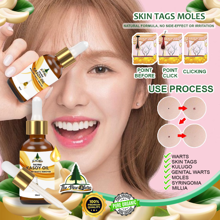 Very Effective Mole & Wart Remover Kasoy Oil 30ML Pure Organic 100% ...