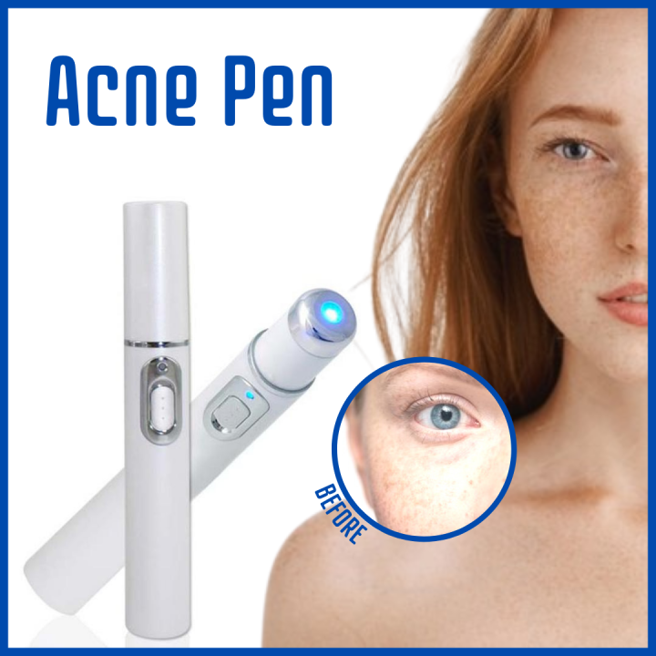 BEAUTY PLUS Acne Pen Laser Pen Treatment Scar Portable High   57bce97949fa68f253951efad436b676  720x720q80 