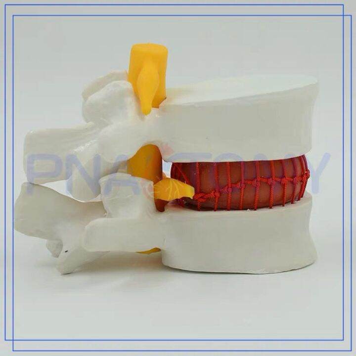 model-of-lumbar-intervertebral-disc-human-intervertebral-disc-extrusion-spine-vertebra-bone-anatomy-medical-teaching-demonstration-teaching-aids