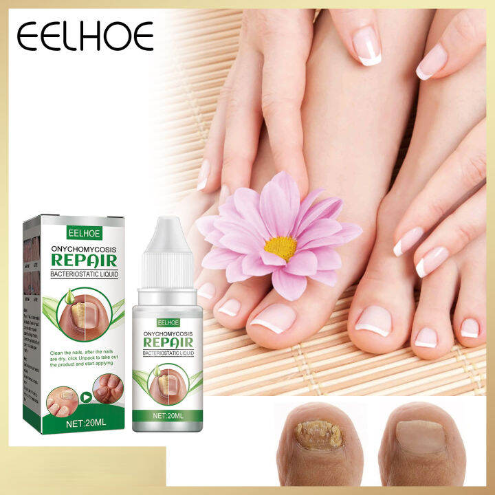 EELHOE onychomycosis repair liquid nail nutrient solution onychomycosis