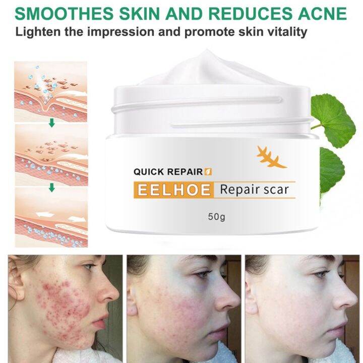 Picture of EELHOE Old Scar Remover for Legs 50g Peklat Remover Acne Surgical ...