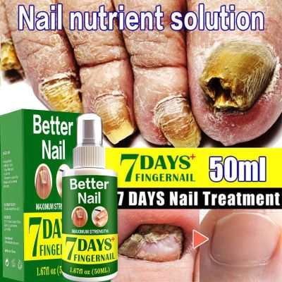 Fungal Nail Repair Spray Nursing Treatment Foot Nail Fungus Removal Gel Anti Infective Paronychia Onychomycosis Care