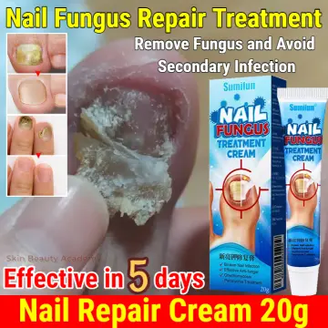 The Best Anti-Fungal Cream That You Will Ever Use