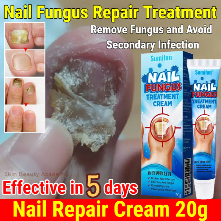 Fungal Nail Treatment Cream Nail Repair Ointment Infection Toenails Care  Promote New Growth Fungal Removal Cream - MedecExpress - Online Shopping  For Medical Consumables,Equipments,Instruments,Devices etc