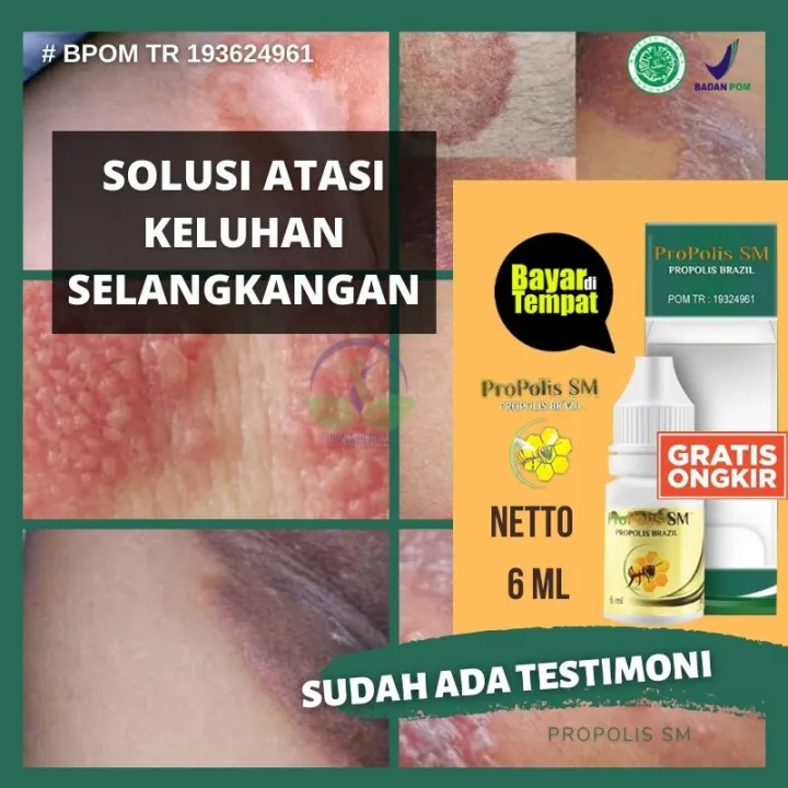 Obat Alami Bentol Gatal Di Pantat Wanita And Pria Salep Oles