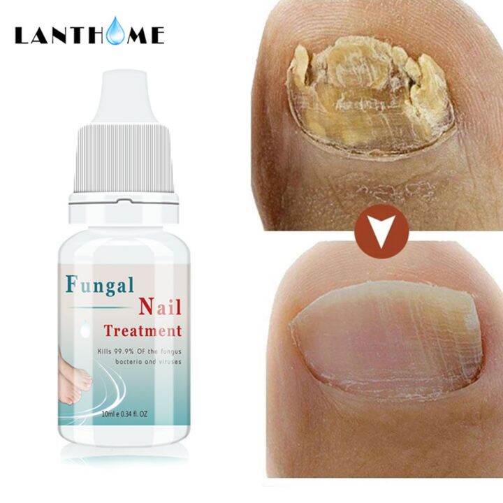 lanthome Nail Repair Essence Serum Fungal Nail Treatment Anti Fungal