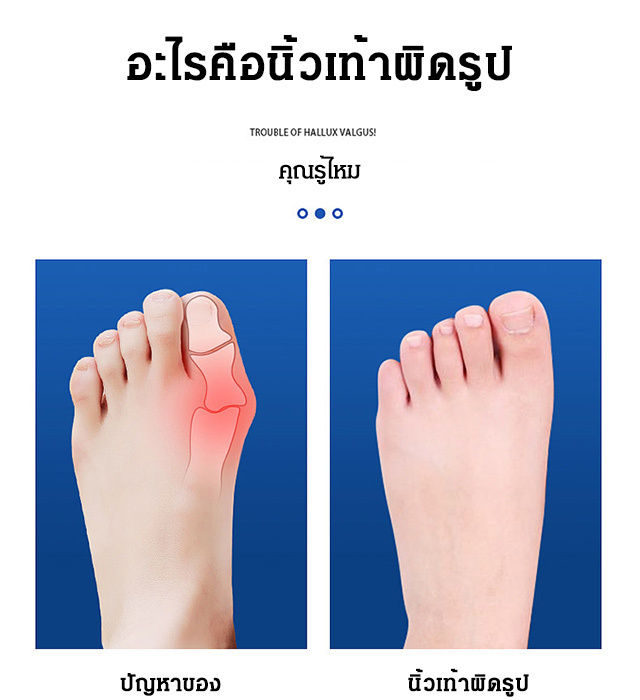 meimingzi-2-in-1-ชุดแก้ไขนิ้วโป้ง-valgus-อัพเกรดแล้ว