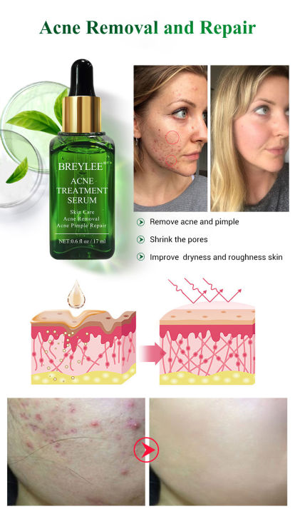 breylee-acne-treatment-kit-ชุดเซ็ท-2-ชิ้น-ครีม-20g-เซรั่ม-17ml-สินค้าพร้อมส่งในไทย-บำรุงผิว-และ-ลดรอยแผลเป็นจากสิว