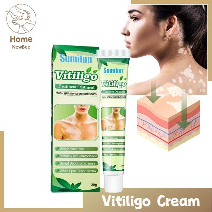 Home NB.Special-effect vitiligo treatment ointment, quick-acting ...