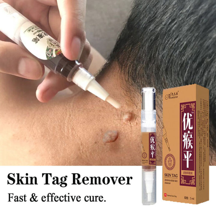 12 Hour Wart Remover Pen Skin Tag Mole Remover Eliminate Foot Corn Wart  Painless