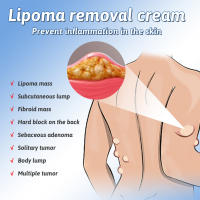 50ml Lipoma Removal Spray Lipolysis Cellulite Fat Lump Nodule Removal Ointment for Men &amp; Women Health Care