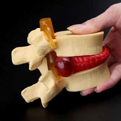 Medical props model Free postage Anatomical Spine Lumbar Disc Herniation Anatomy Medical Teaching Tool