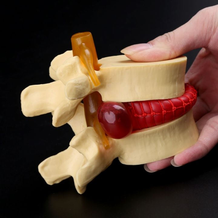 medical-props-model-free-postage-anatomical-spine-lumbar-disc-herniation-anatomy-medical-teaching-tool