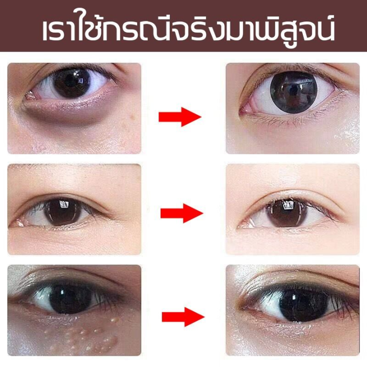 จัดส่งจากกรุงเทพฯ-aichunครีมบำรุงรอบตา-เซรั่มทาถุงใต้ตา-แก้ปัญหารอบดวงตา-ลบรอยคล้ำใต้ตา-ถุงไขมันใต้ตา-ถุงใต้ตา-ริ้วรอย-รอยตีนกา-เม็ดไขมัน-เซรั่มถุงใต้ตา-ขอบตาดำ-ครีมทารอบดวงตา-บำรุงสายตา-eye-bag-remov