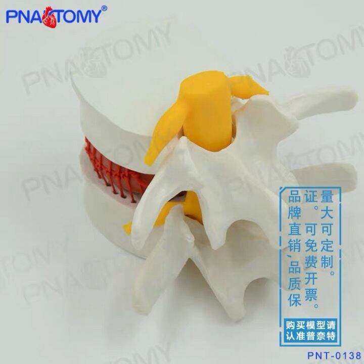 model-of-lumbar-intervertebral-disc-human-intervertebral-disc-extrusion-spine-vertebra-bone-anatomy-medical-teaching-demonstration-teaching-aids