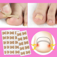 Miss Lan 10 pcs Ingrown Toenail Sticker Glue-Free Toe Nail Correction File Patch Paronychia Corrector Foot Care Treatment Pedicure Tool  toenail Softe